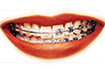 Straight Teeth and Braces